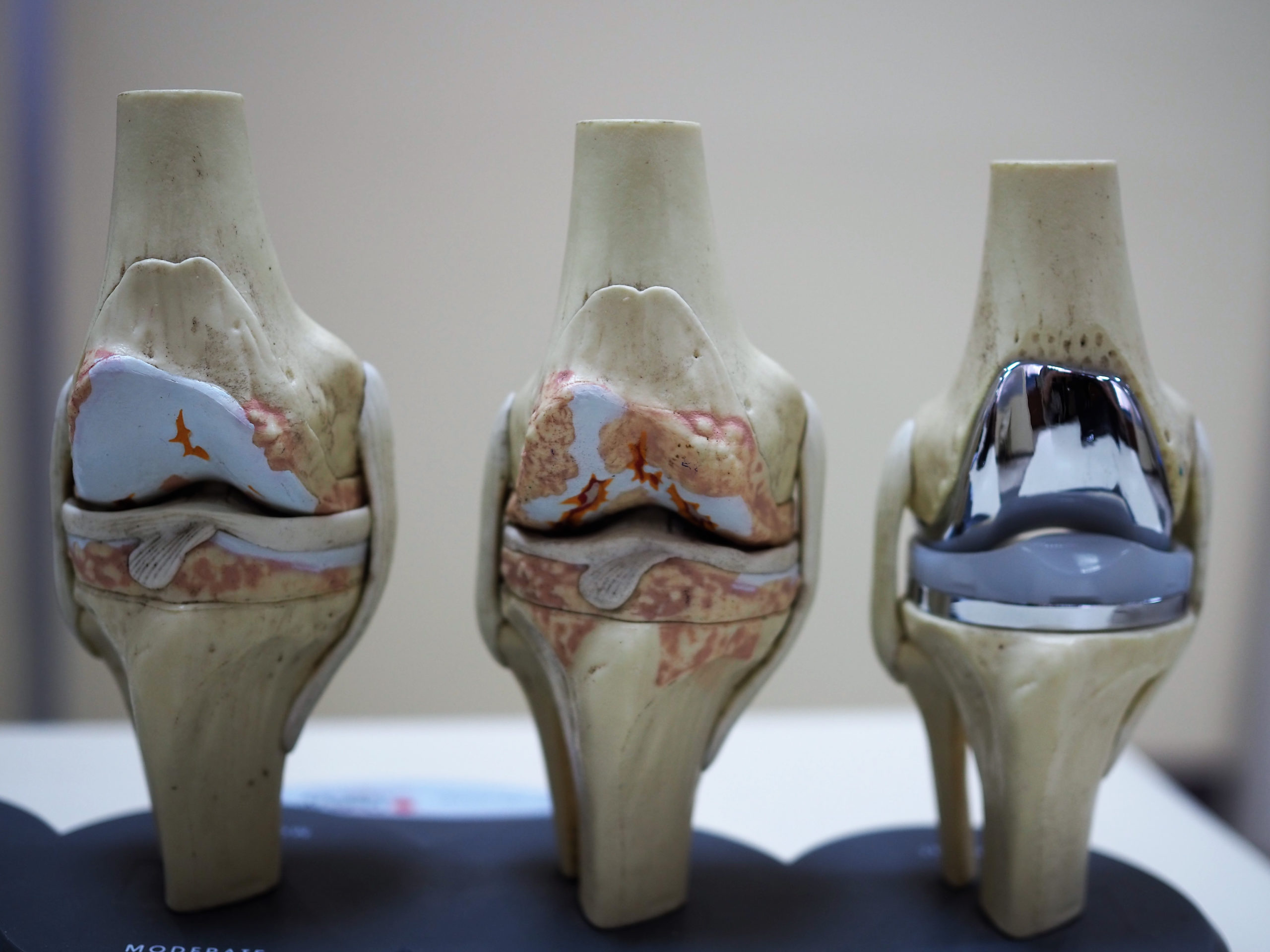 Knee replacement innovations in Asia Pacific